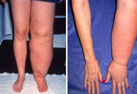 Lymphedema